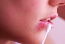 Herpes Genital Humano Evoluciona Más Rápido que el Labial