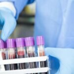 Identifican en Sangre Señales de Advertencia de la Demencia