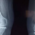El 80% de Pacientes con Osteoporosis, sin Tratamiento ni Diagnóstico Adecuado